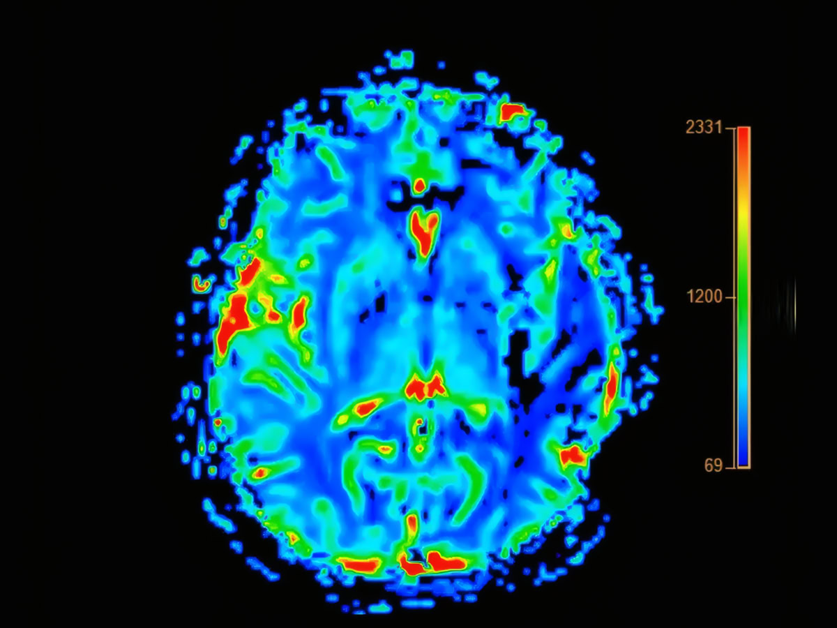 Νέα ελπίδα για το Αλτσχάιμερ από θεραπεία που προστάτευσε τη μνήμη σε ποντίκια